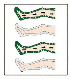 Neomedic INTERMITTENT NON-SEGMENTAL COMPRESSION CIRCULATOR