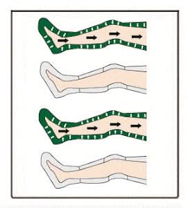 Neomedic INTERMITTENT NON-SEGMENTAL COMPRESSION CIRCULATOR